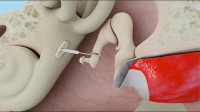 Implante en otosclerosis
